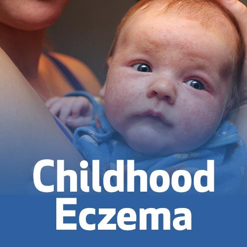 Childhood Eczema